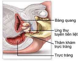 paraproctită și prostatita control prostate enlargement