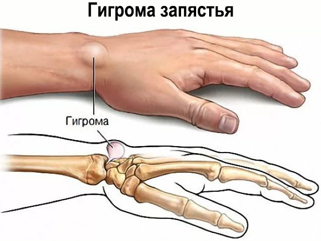 Artrita care tratează. Totul despre artrita: tipuri, simptome, diagnostic, tratament